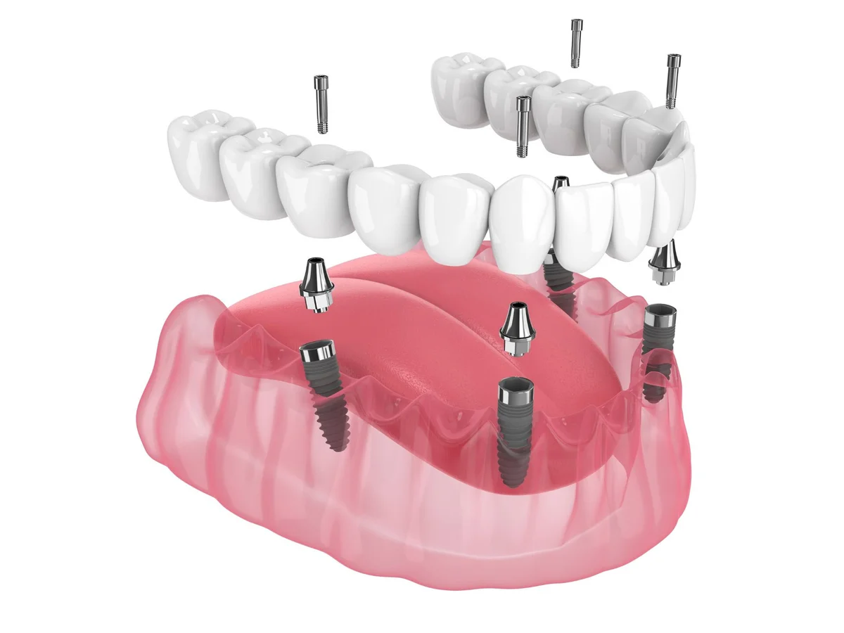 Restaurare estetica la OnSmile Iași